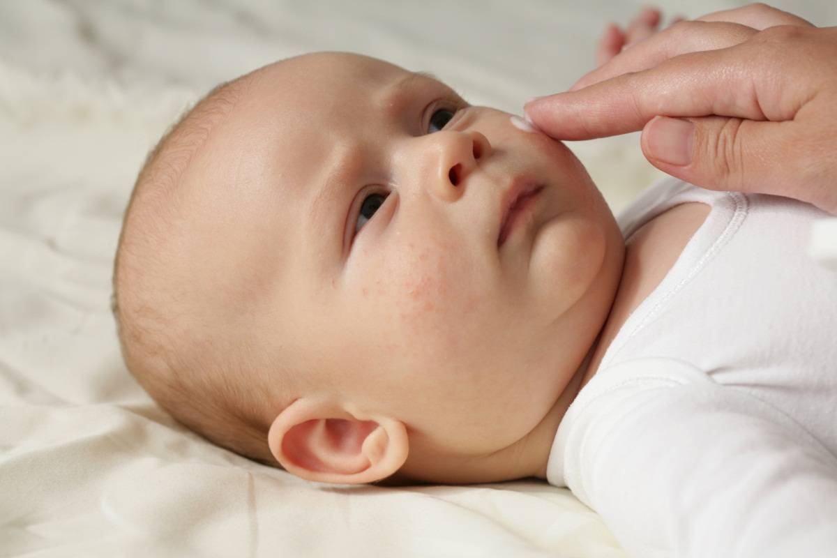 宝宝的疹子到底是什么原因？常见的婴儿痤疮、脂溢性皮炎和湿疹，怎么应对怎么区分？看这篇就够了！