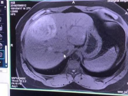 PDD得了癌症?沈灵敏证实:是真的 网友:希望P