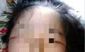 丁香病例 | 14 岁女孩一发病就「七窍流血」,究竟是什么病?