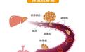 肿瘤都“浪”到哪去了?一图读懂常见肿瘤转移途径