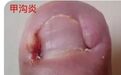 甲真菌病(灰指甲)小病大危害