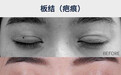 大连刘志刚眼修复小讲堂(四)双眼皮能做第二次吗?