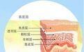 银屑病会引发白血症?这几点来告诉你是什么原因