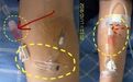留置针肝素帽取下后,你还打算继续使用吗?