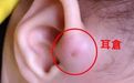 耳前瘘管你知多少?