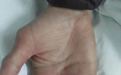 女子手指长小疹子险截指,这些方法要不得!