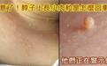 脖子上长小肉粒是怎么回事?