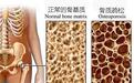 营养界限:骨质疏松的膳食营养治疗