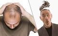 Nature子刊:GWAS研究发现男性型秃发的新基因位点,与其他复杂性状存在潜在联系