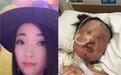 广东一女孩烧伤生命垂危 其母在探望途中车祸身亡