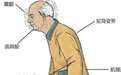 帕金森手术费可报销八成,20万元的费用个人只掏5万
