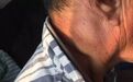 耳后长了个小疙瘩,杭州男子隔了半年才去医院,结果晚了……