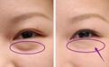 眼袋下垂就打玻尿酸?别傻!屈臣氏有个“黑科技”,2分钟没眼袋