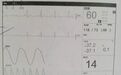 心电监护仪上的这个数值你认识吗?