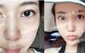 去除下眼袋的两种常用手术!溪峰聚美仕