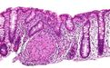 Cancer Res:科学家揭示结肠癌新起源