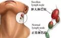 淋巴癌的9种常见分型