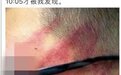 高二男生上课讲话,被老师连扇十几耳光脑震荡住院