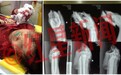 “江西11岁女孩双手被砍断”续:现已接上 手指能动