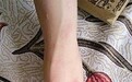 儿子游完泳,半夜全身起红疹奇痒难忍