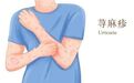 得了荨麻疹和哪些因素有关?会不会影响患者的健康?