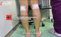 【女孩为瘦做 #小腿肌肉阻断术# 医生:会影响正...