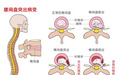 腰椎间盘膨出了,吃舒筋健腰丸有效果吗?