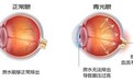 为保护视力而战:五项建议预防和有效控制青光眼