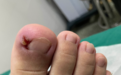 17 岁孩子甲沟炎反复 3 年,拔掉整个趾甲后,我惊呆了…