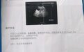 阴道流黄水,子宫内像「章鱼足」一样错综复杂,不是 CA