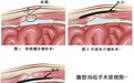 科普|大腿根部出现肿块后又消失了?腹股沟疝究竟是什么?