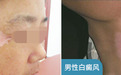【医讯】合肥华研白癜风医院口碑到底好么-11月17-19日皮肤病专家【张虹亚、弓娟琴教授】在合肥华研白癜风医院会诊