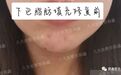 郭鑫医生科普:下巴脂肪填充修复