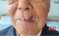83岁老人嘴角黑痣越长越大,一查才知脸上长了“癌”