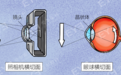 【合肥爱尔】这种情况也会得白内障!为啥年轻人也得白内障?