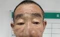 鼻头反复感染未就医,老人鼻子肿至鹅蛋大