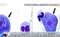家长注意!儿童玩水后感染“食脑虫”,专家解读→