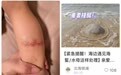 游客在北海海滩游泳时被水母蜇伤,景区:被蜇后要及时前往医务室