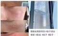 “飞行的硫酸”又来了?北方多地现隐翅虫,准新娘沾上它双脸红肿