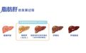 “减重针”开始治脂肪肝,哪些人需要打?