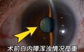 超高度近视遇上白内障,佛山爱尔何锦贤院长“飞白+三焦点”助54岁大叔重获高清视界