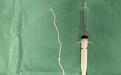 75岁婆婆乳房瘙痒手术竟取出30厘米活虫!医生:千万别吃生肉