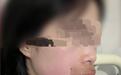 巴中女子婚礼前被马蜂蜇伤,嘴唇肿胀自嘲像蛤蟆精,当事人:婚礼如期举行