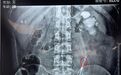 云南结石病医院案例分析:多次反复碎石,反致肾功能受损、尿潴留