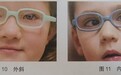 科学视训显成效!11岁间歇性外斜视患儿在宁波爱尔获斜视、近视双改善
