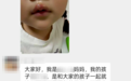 当地通报“幼儿园教师疑用热熔胶烫伤小女孩”:涉事教师被停职,公安部门对其立案调查