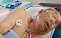 七旬夫妇天桥散步遭马蜂群围攻被送进ICU,女儿:父亲全身被蜇伤200多处,目前靠呼吸机维持生命