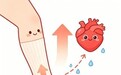 科普|医用弹力袜≠网红瘦腿袜,哪些人群适合穿戴弹力袜?