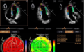自动左心室应变评估 Auto Strain LV,让心肌应变检测不再需要心电图的“入场券”