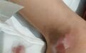 5岁男孩腋下包块一个月疯长,多家医院无解,妈妈一句话成“破案关键”